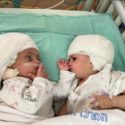 Twins conjoined at the head were separated after a rare 12-hour surgery, meaning they can see each other for the first time